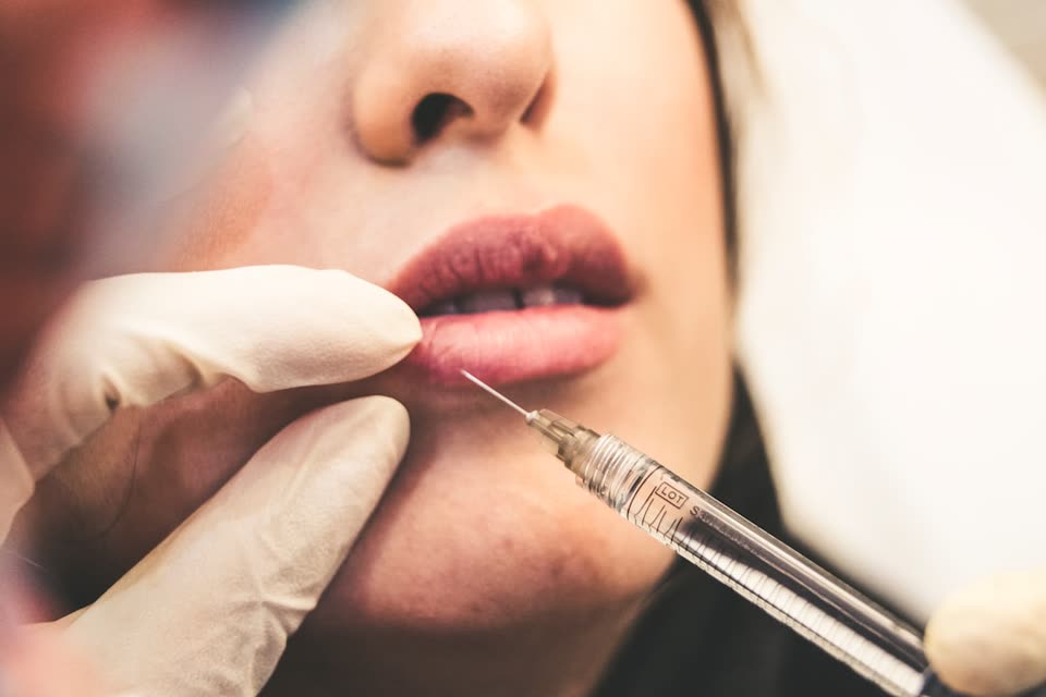 Gloved practitioner administering a lip filler injection with a fine-gauge syringe